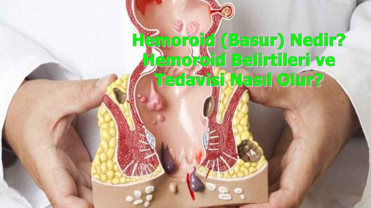 Hemoroid (Basur) Nedir? Hemoroid Belirtileri ve Tedavisi Nasıl Olur?